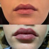 Lippenvolumen